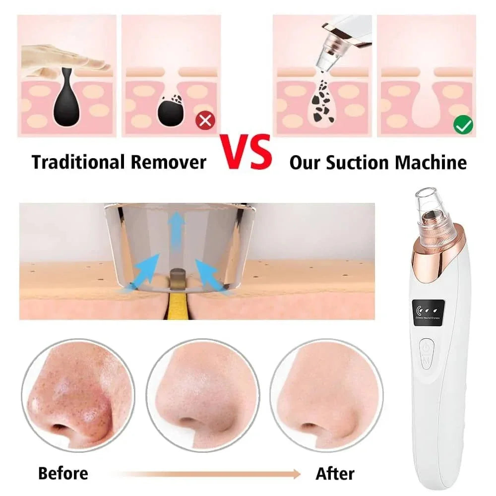 Electric Blackhead Remover Vacuum – 5-Head Pore Cleaner & Facial Suction Tool