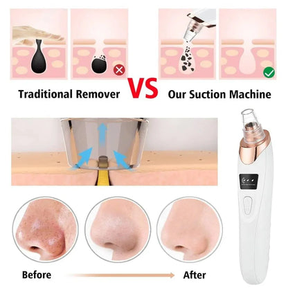 Electric Blackhead Remover Vacuum – 5-Head Pore Cleaner & Facial Suction Tool