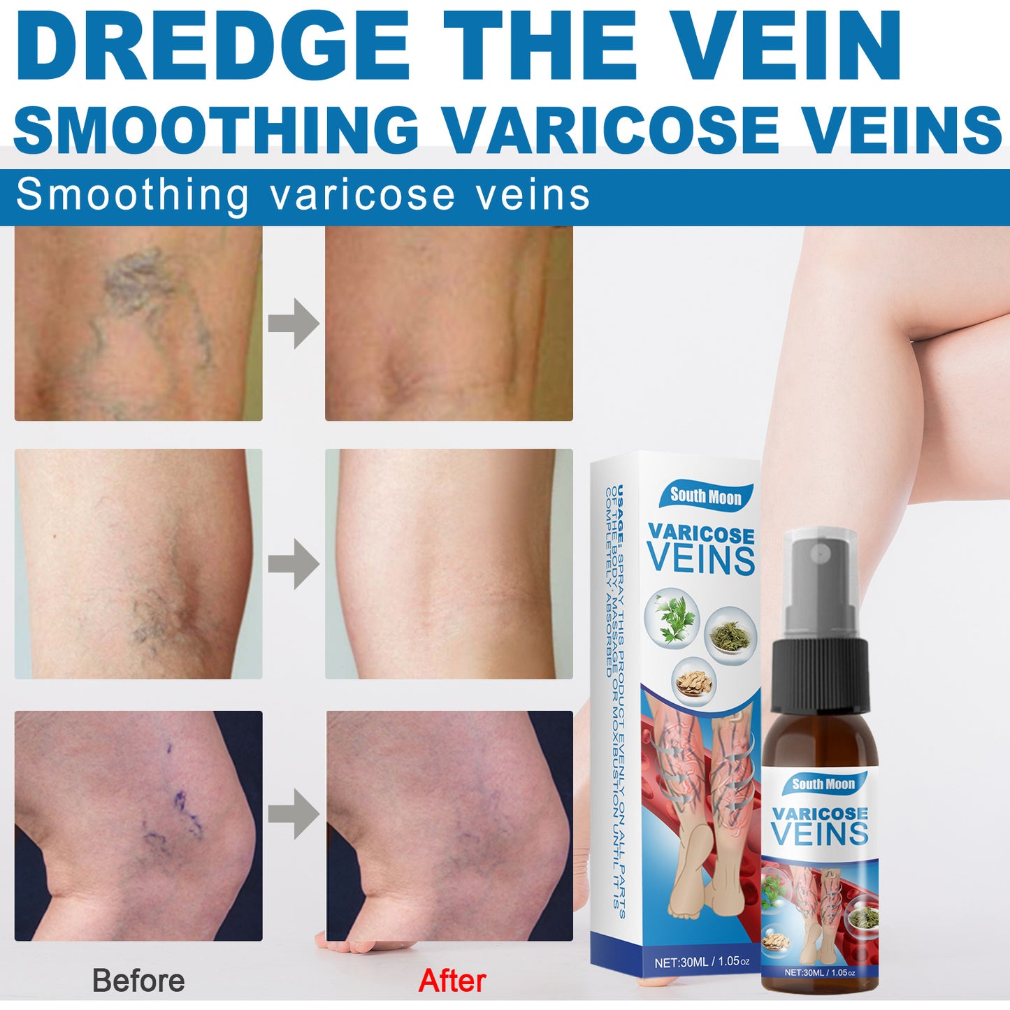 VenoRelief™ Varicose Vein Support Spray–Soothing Leg Care-30ml